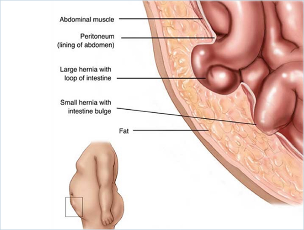 Umbilical hernia: What is it, symptoms and repair